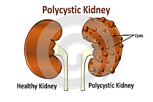 polycystic kidney disease photo