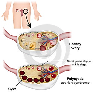 Polycystic ovarian syndrome medical  illustration photo