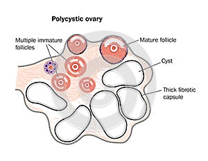 Polycystic ovary photo