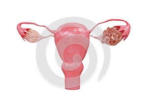 Polycystic Ovary Syndrome A hormonal disorder that causes an increase in the size of the ovaries with small cysts on the outside photo