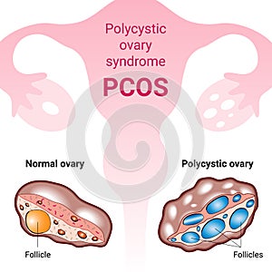 Polycystic ovary syndrome PCOS, hormonal diagnose, medical illustration photo