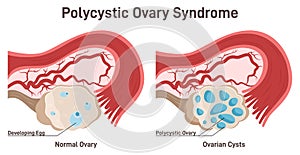 Polycystic ovary syndrome. PCOS hormonal disease. Female reproductive