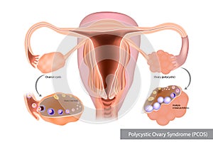 Polycystic Ovary Syndrome or PCOS. Multiple immature follicles or Ovarian cysts photo