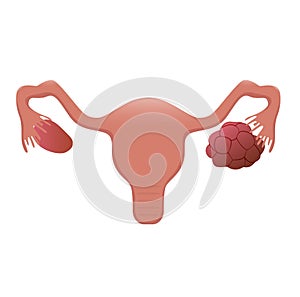 Polycystic ovary vector illustration photo