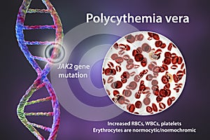 Polycythemia vera, a rare slow-growing blood cancer with an increase in the number of red blood cells photo