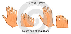 Polydactyly before and after surgery