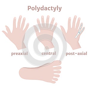 Polydictal hands and feet. Multi-fingering.