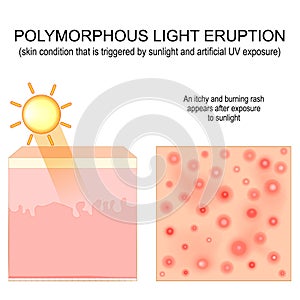 Polymorphic light eruption
