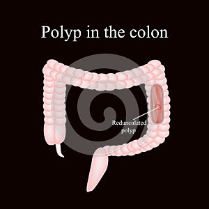 Polyp in the intestine. Polyp in the colon. Vector