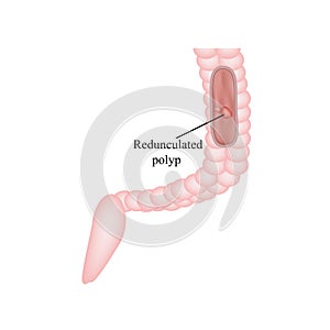 Polyp in the intestine. Polyp in the colon. Vector