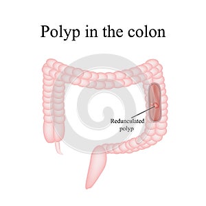 Polyp in the intestine. Polyp in the colon. Vector