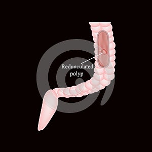 Polyp in the intestine. Polyp in the colon. Vector illustration on a black background