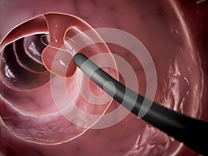 Polyp removal