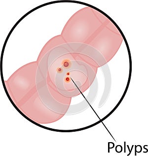 Polyps in  intestine disease photo