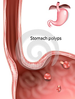 Polyps in Stomach. Gastric polyp. Medical illustration