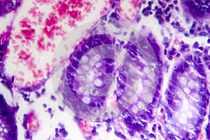 Poorly differentiated intestinal adenocarcinoma , light micrograph