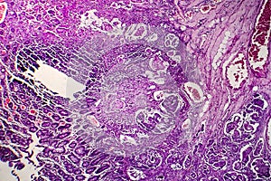 Poorly differentiated intestinal adenocarcinoma , light micrograph