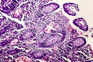 Poorly differentiated intestinal adenocarcinoma , light micrograph