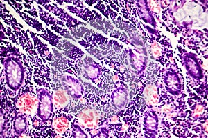 Poorly differentiated intestinal adenocarcinoma , light micrograph