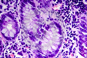 Poorly differentiated intestinal adenocarcinoma , light micrograph