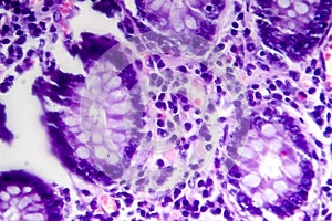 Poorly differentiated intestinal adenocarcinoma , light micrograph