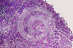 Poorly differentiated intestinal adenocarcinoma , light micrograph