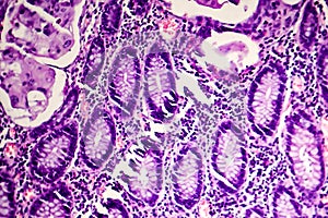 Poorly differentiated intestinal adenocarcinoma , light micrograph