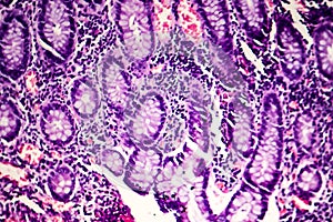 Poorly differentiated intestinal adenocarcinoma , light micrograph
