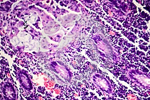 Poorly differentiated intestinal adenocarcinoma , light micrograph
