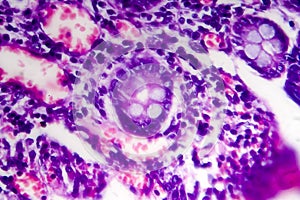 Poorly differentiated intestinal adenocarcinoma , light micrograph