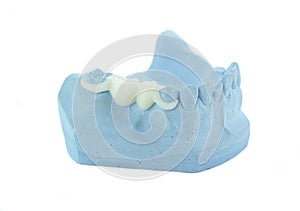 Porcelain bridge on blue model