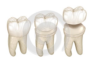 Porcelain crown placement over molar tooth. Medically accurate 3D illustration