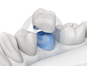 Porcelain crown placement over premolar tooth. Medically accurate 3D illustration