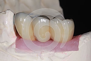 A porcelain fuse to metal dental bridge with high translucency porcelain which mimic the natural teeth color