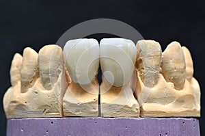 Porcelain teeth dental implant