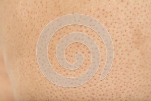 Pores on the body in women