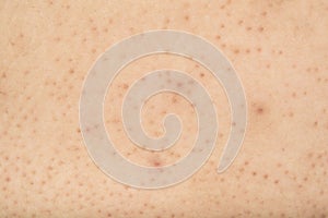 Pores on the body in women