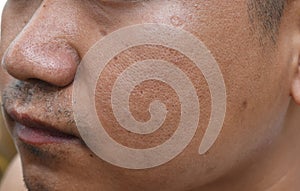 Pores and oily on surface young asian man face skin do not take care for a long time