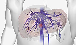 Portal vein thrombosis (PVT) is the occlusion of the portal vein by a blood clot (thrombus