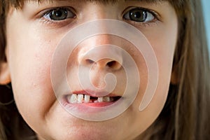 Portrait of adorable kid missing her first milk tooth.  Lifetime moments and happy childhood concept. Close up