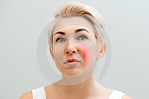 Portrait of caucasian adult beautiful woman with inflammation on her cheek. The concept of rosacea and aesthetic