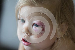 Portrait of caucasian child of two years old with the bruise on face on left eye