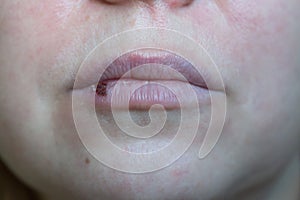 portrait of a Caucasian woman with herpes on her lips. skin problems, inflammation of the herpes virus on the face and lips