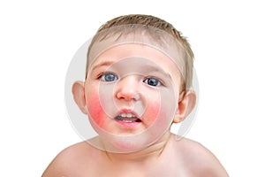 Portrait of a child with allergies on the cheeks and chin. Toddler baby b