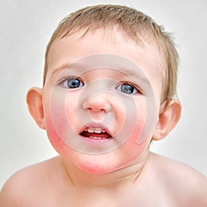 Portrait of a child with allergies on the cheeks and chin. Toddler baby b