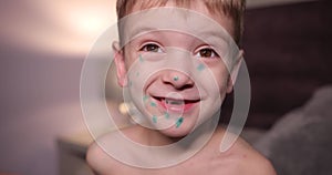 portrait of a happy boy sick with chicken pox. baby looks straight into the camera and smiles. a chickenpox patient sits