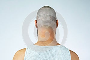 Portrait of a head bald guy with alopecia, back view