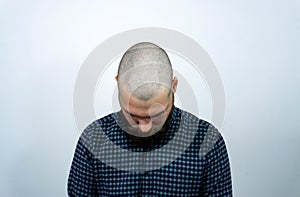 Portrait of head bald man with alopecia, top view