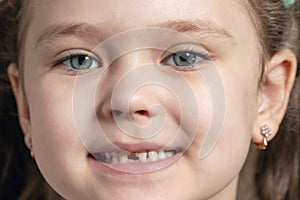 Portrait of a little girl with fallen and broken baby teeth