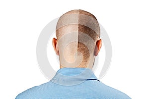 Portrait Man before and after hair loss, transplant on isolated white background. Split personality, Back view